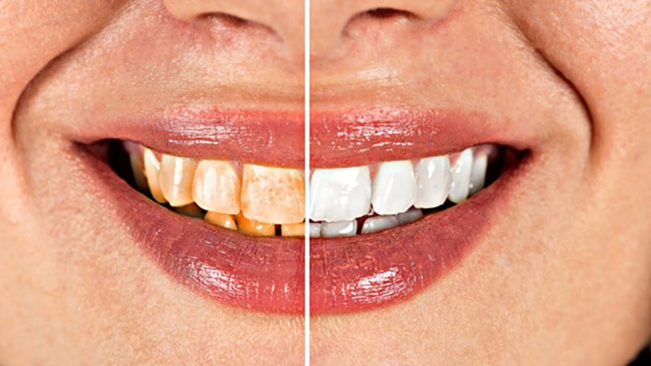 Teeth Whitening Tips