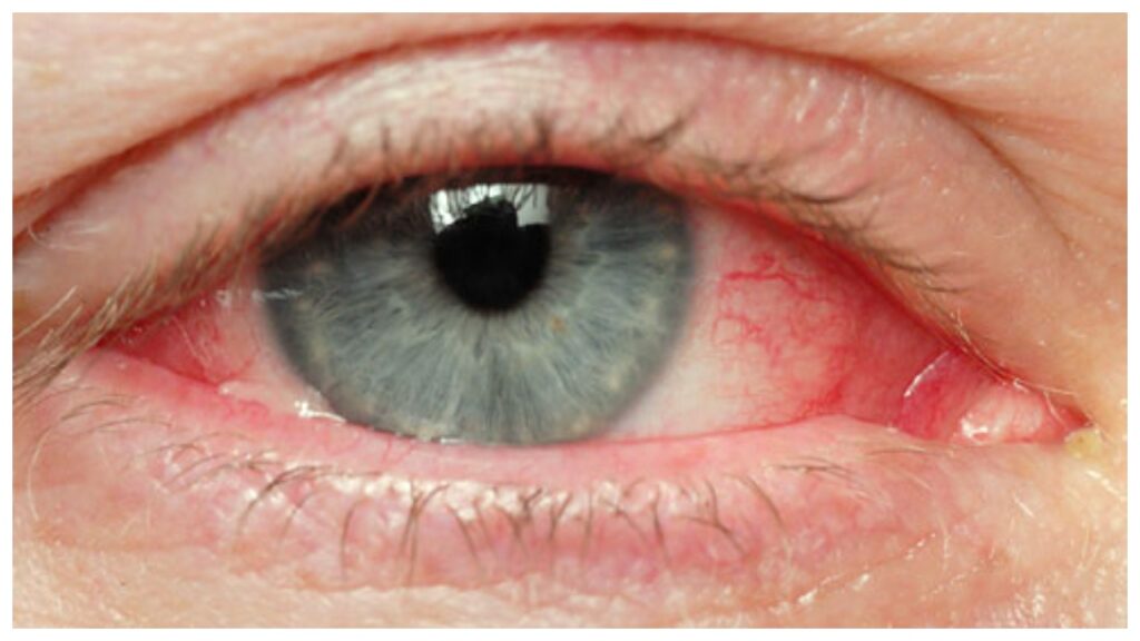 allrgic conjunctivitis
