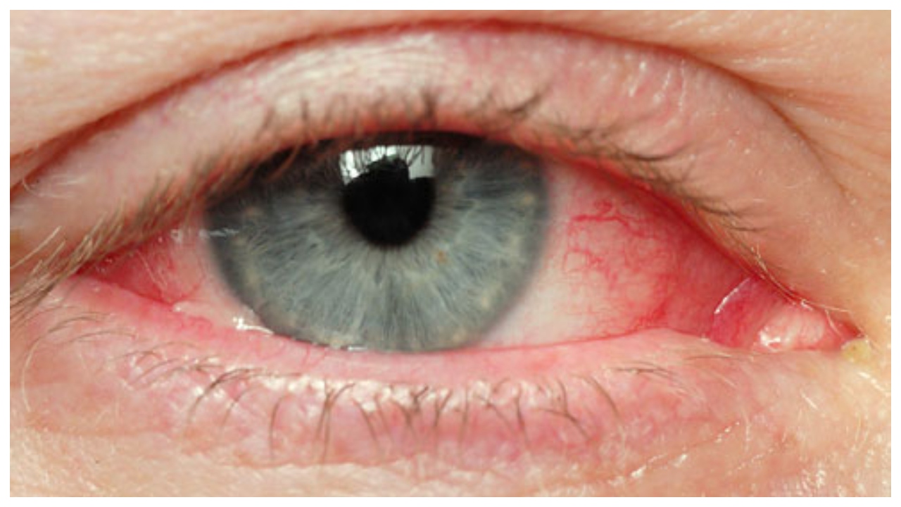 allrgic conjunctivitis