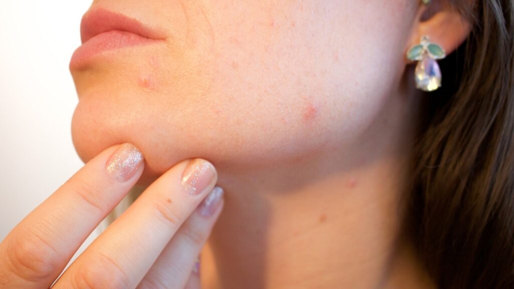 Home Remedies For Skin Pigmentation Home Remedies For Skin Pigmentation