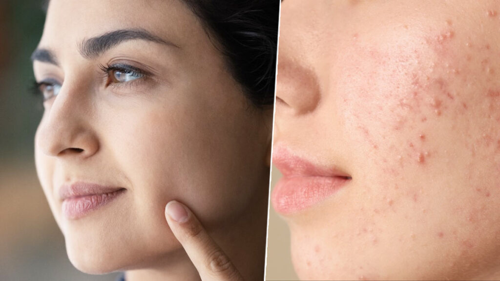 Nighttime Skin Care Routine for Oily Skin