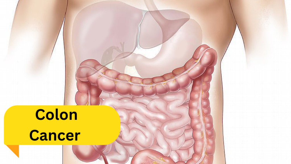 Colon Cancer