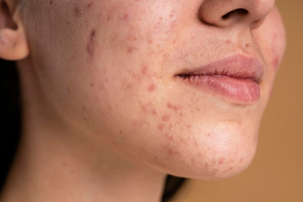 confident young woman with acne close up 23 2148982535 confident-young-woman-with-acne-close-up_23-2148982535