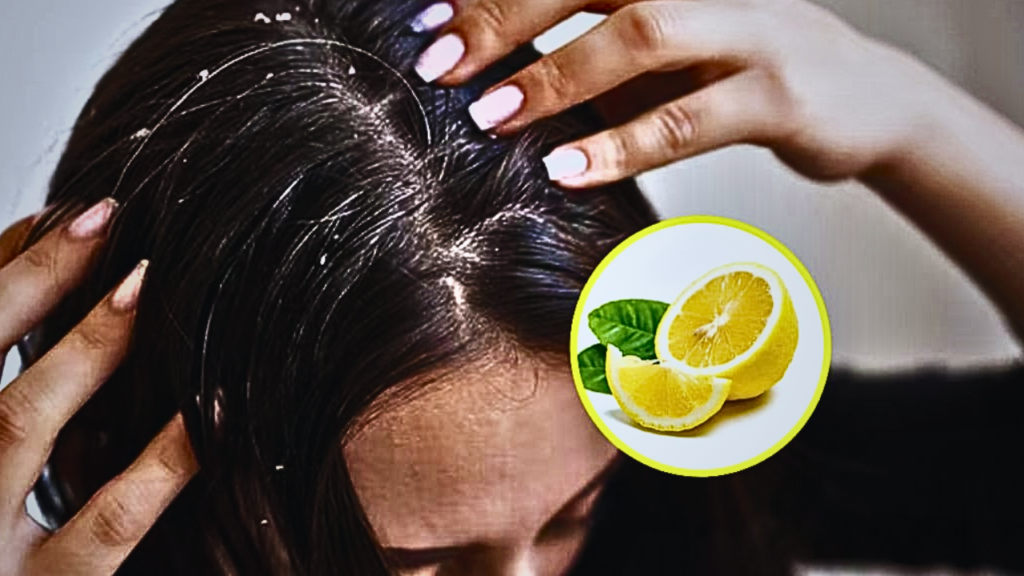 dandruff3 dandruff3