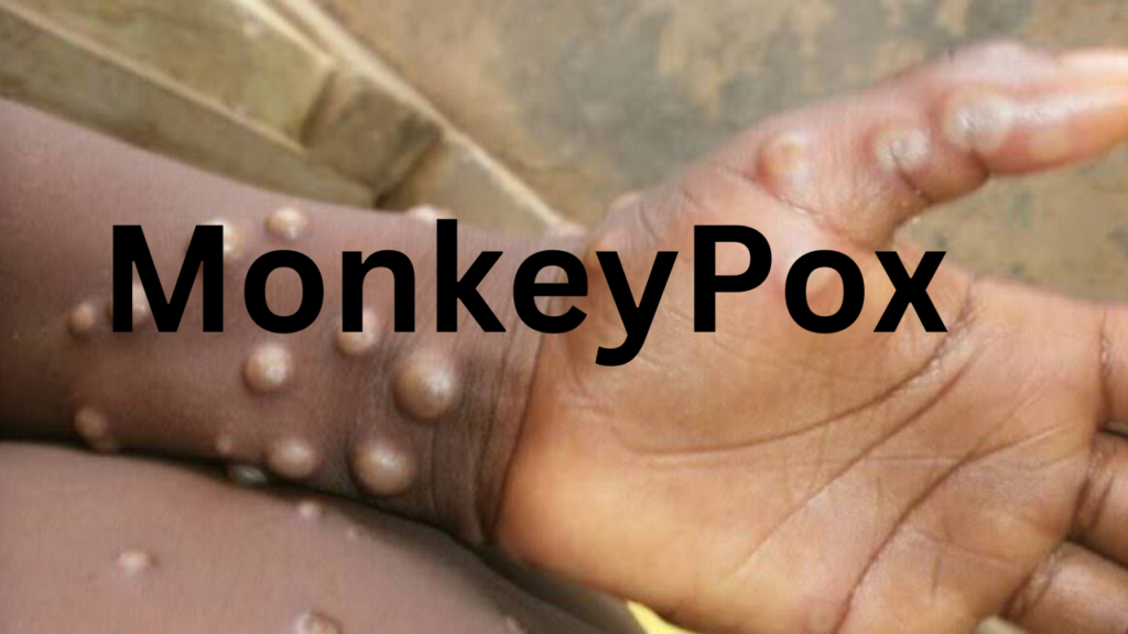 MonkeyPox MonkeyPox