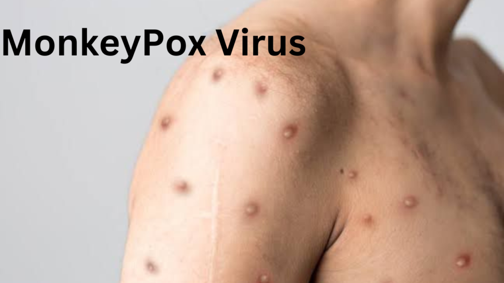 MonkeyPox 1 MonkeyPox 1