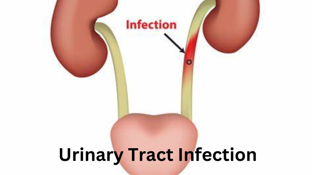 UTI Infection 1 UTI Infection 1