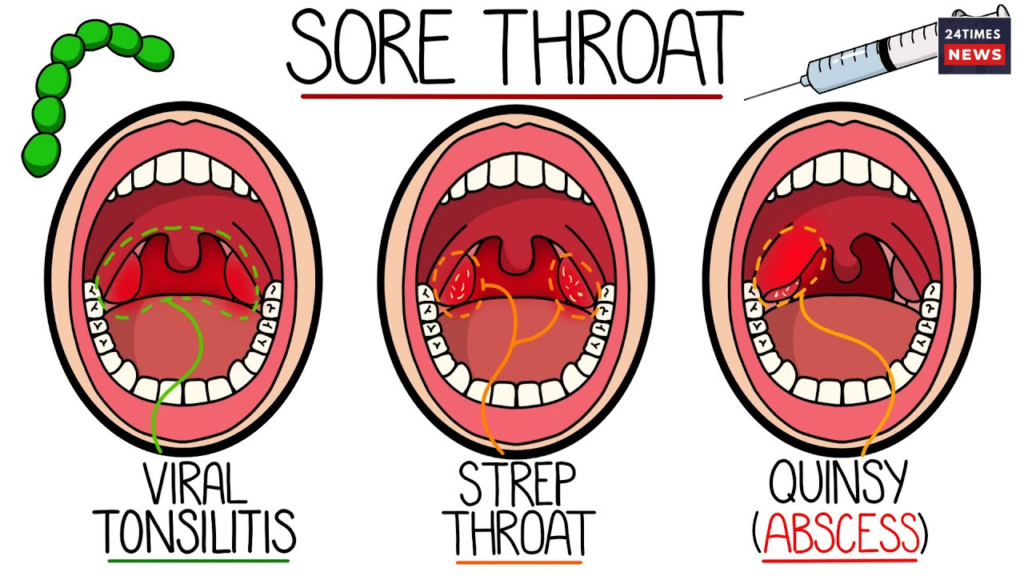 Untitled design 2025 03 23T003215.051 Sore Throat