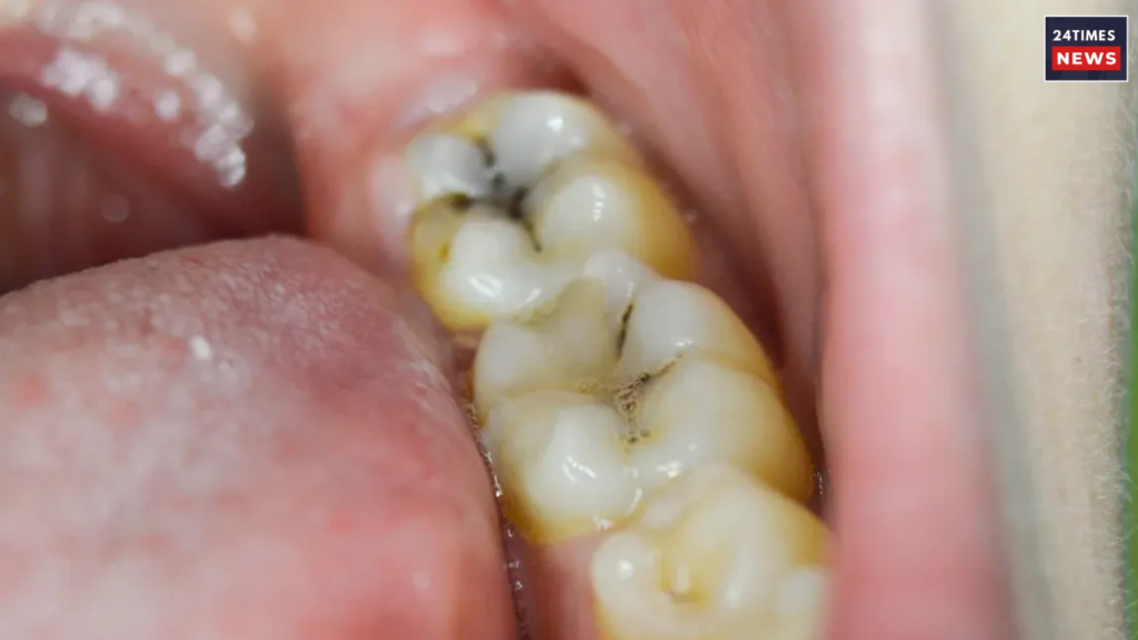 Untitled design 2025 06 04T142956.862 Tooth Decay
