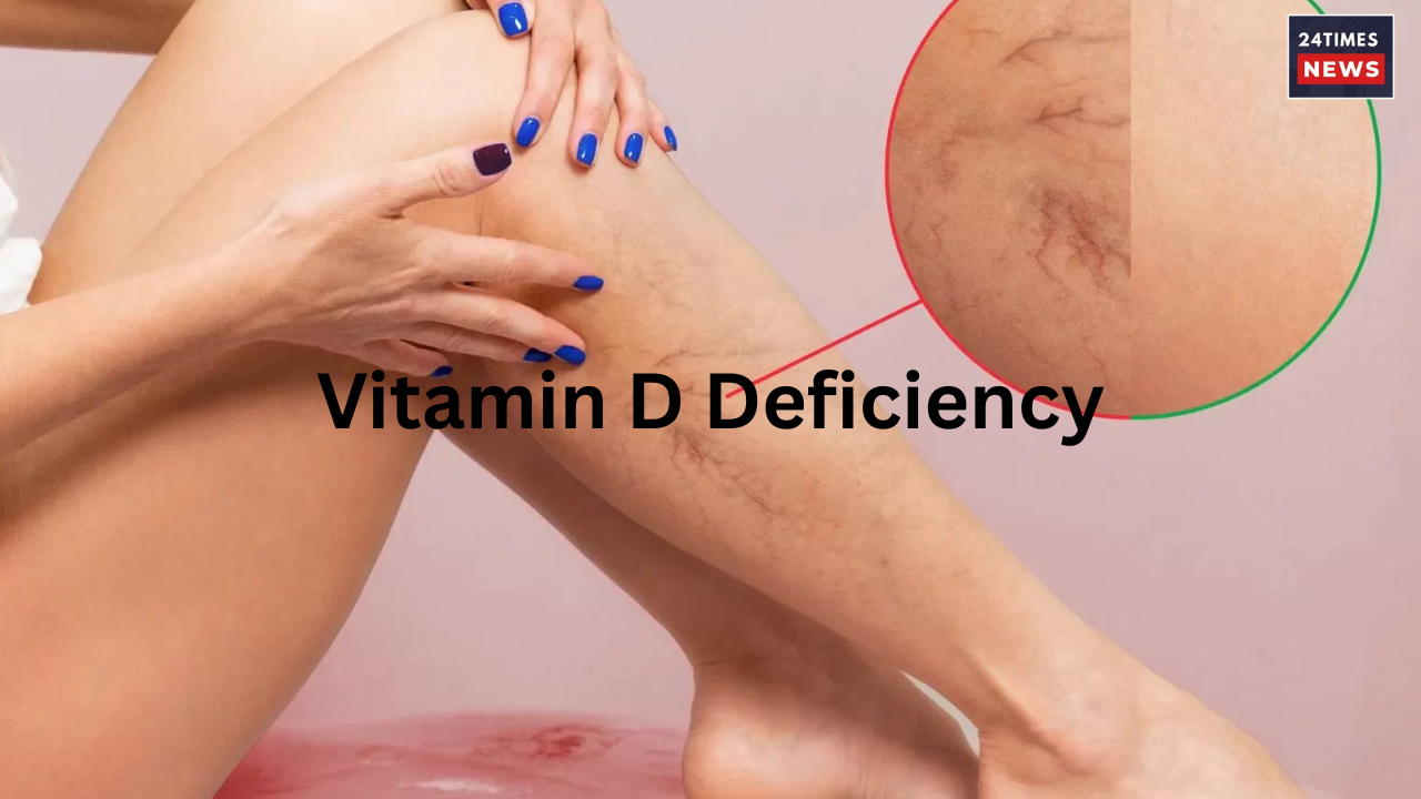 Vitamin D Deficiency