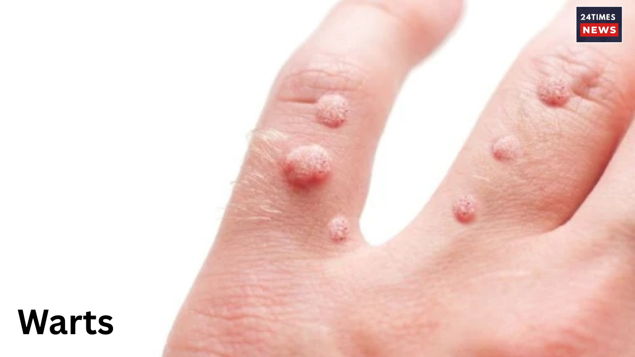 Warts