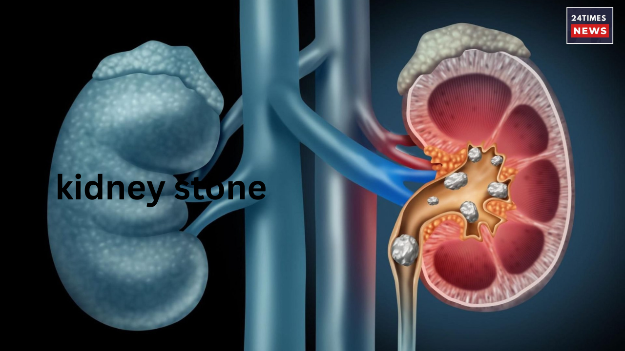 kidney stone
