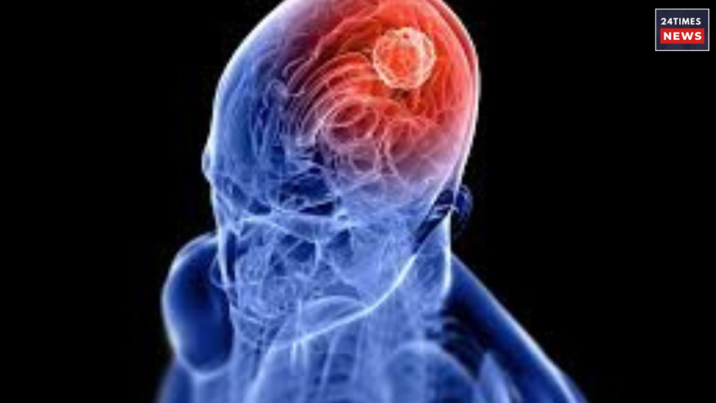 brain tumor brain tumor