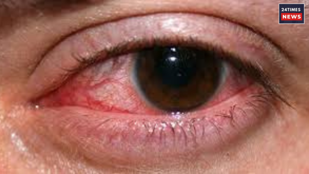 eyes infection eyes infection