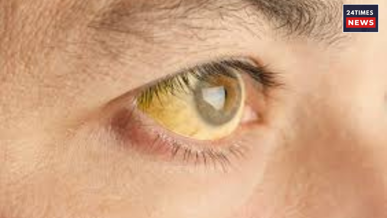 hepatitis