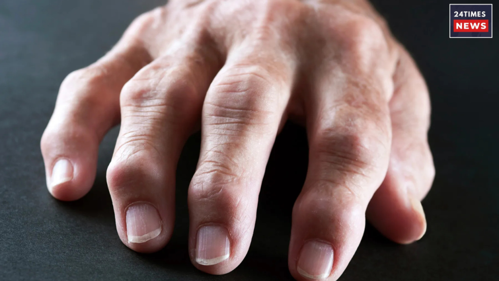 arthritis arthritis