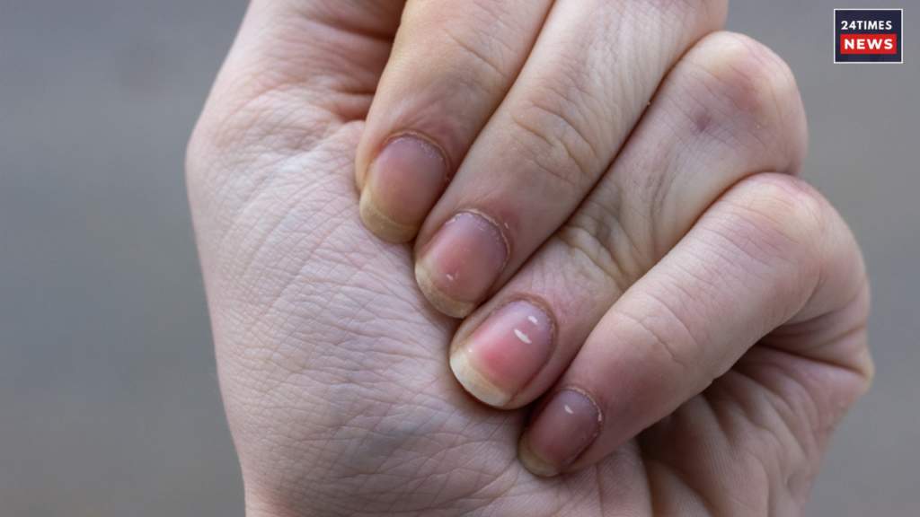 white spots on nails white spots on nails
