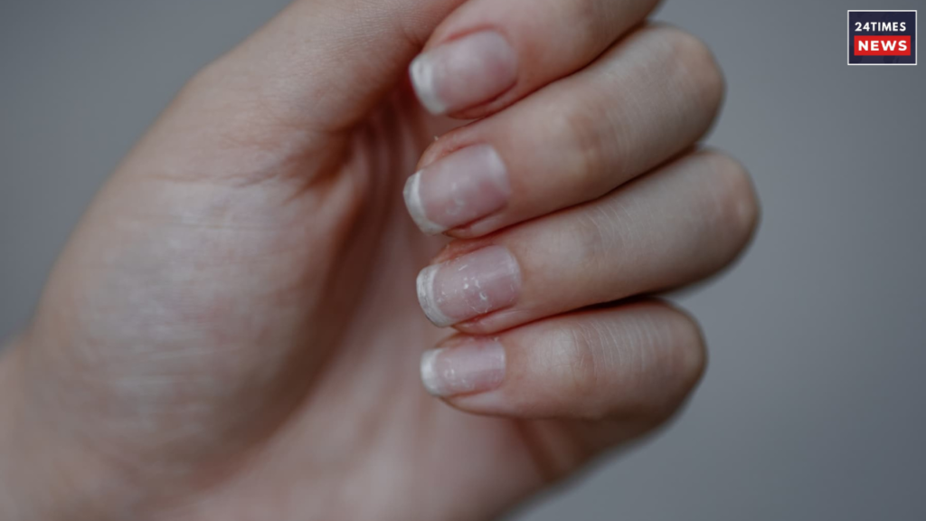 white spots on nails 1 white spots on nails 1