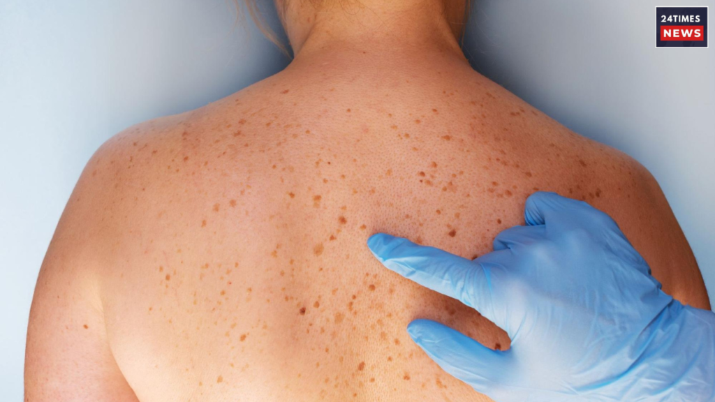 Untitled design 2025 09 09T181833.028 skin cancer