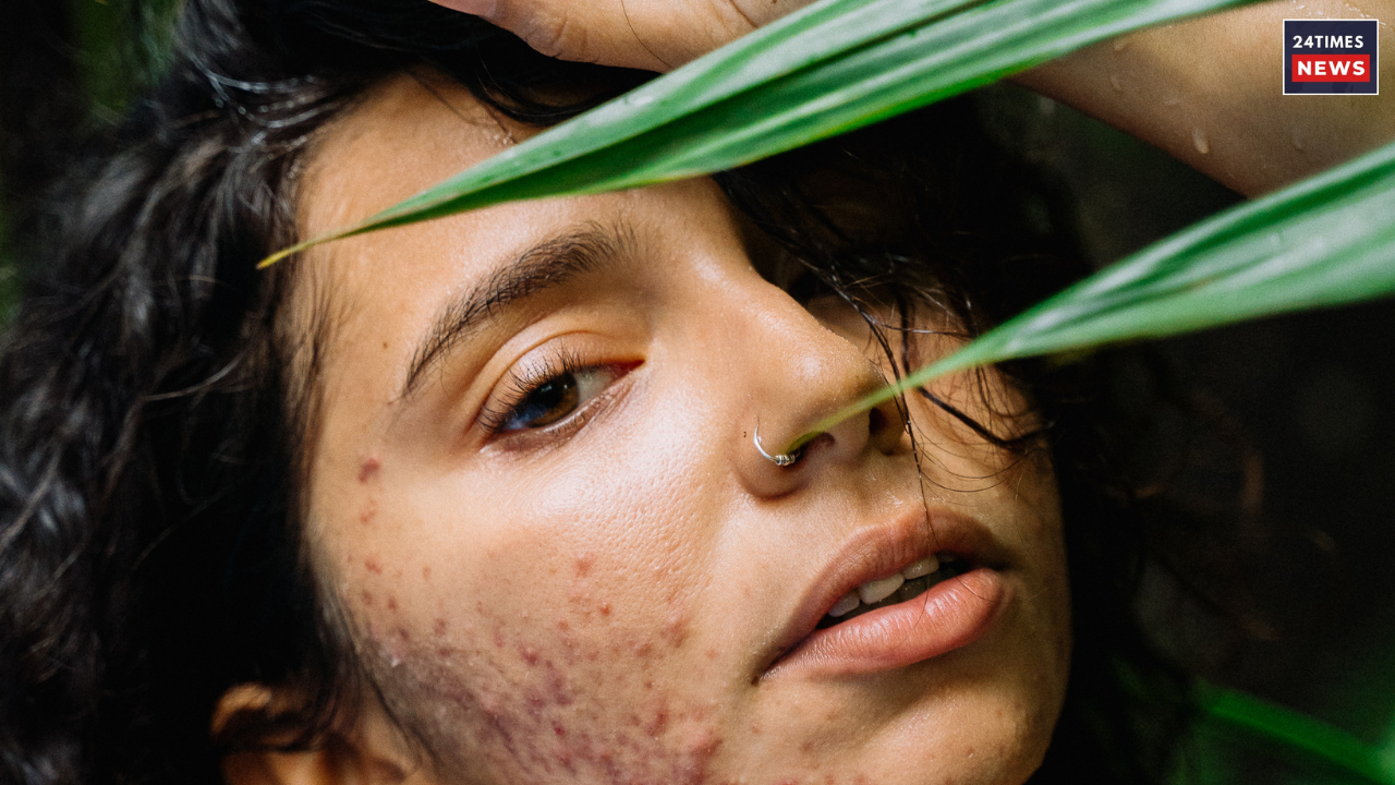 acne skin 1