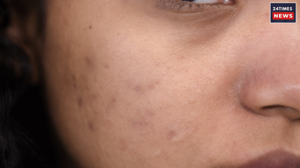 dark circles dark circles