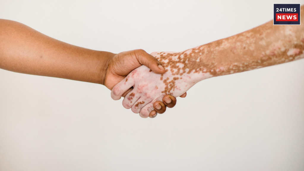 vitiligo 1 vitiligo 1