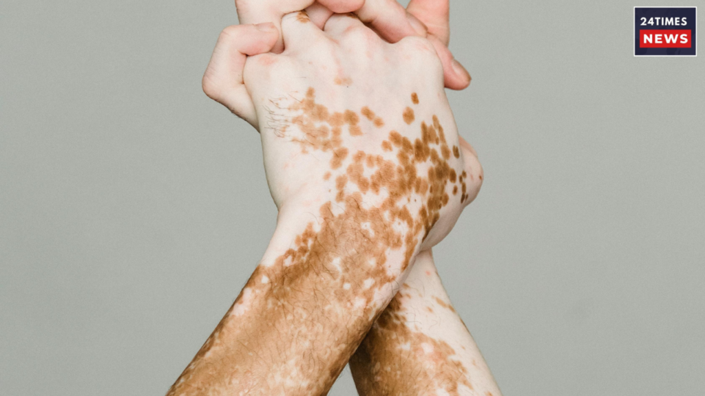 vitiligo vitiligo