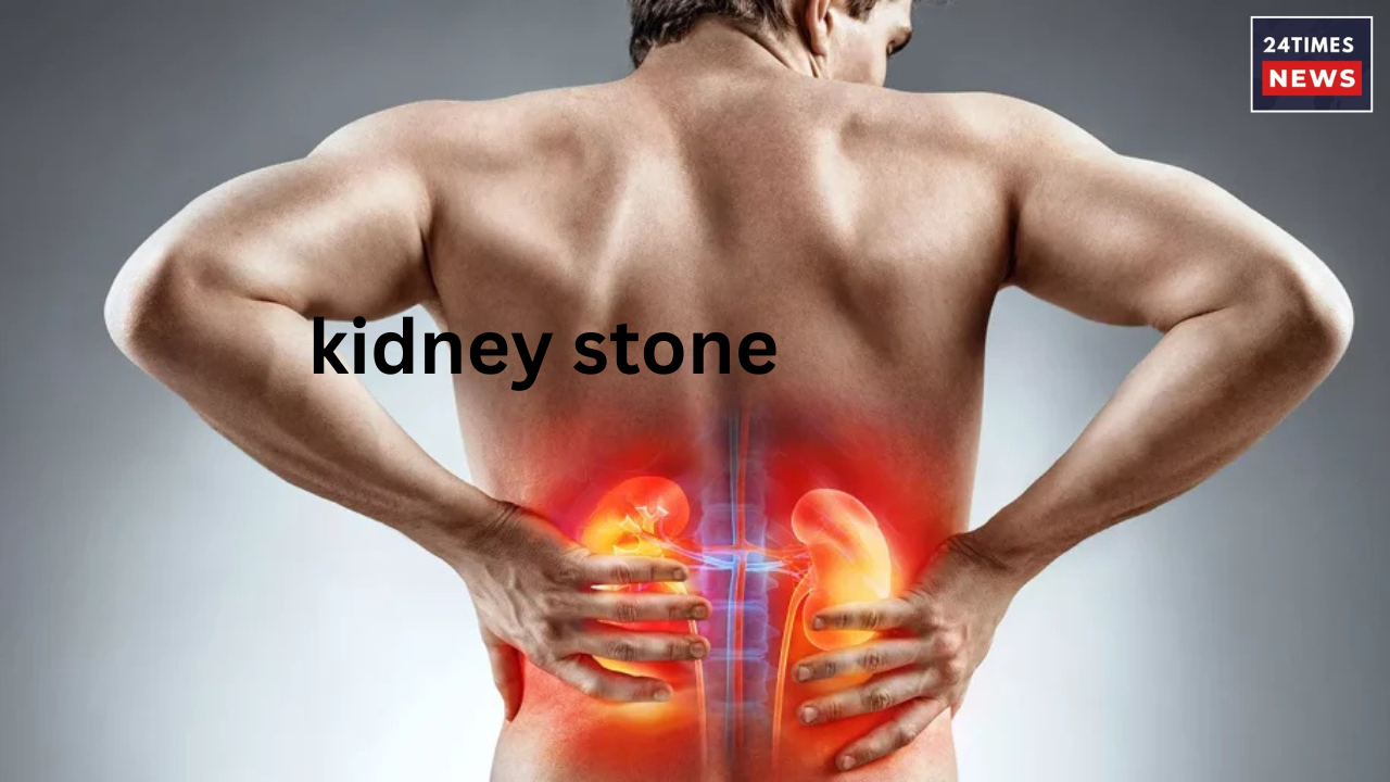 kidney stone 1