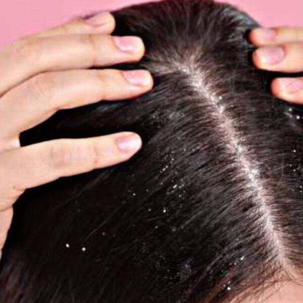 Hair Care Tips: Get rid of dandruff in winter with this trick