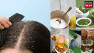 dandruff hair packs : Dandruff will be gone, these three magical hair pack will remove it