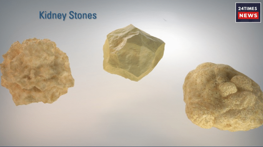 kidney stones