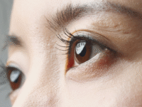 eyes infection 1