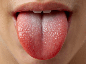 Why do mouth ulcers happen? Learn easy home remedies to prevent them