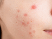 open pores