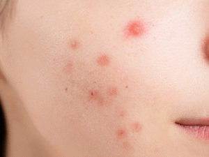 Want to Reduce Open Pores on the Skin? Here’s How You Can Take Care of Them Naturally and Effectively