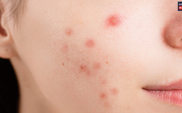 open pores