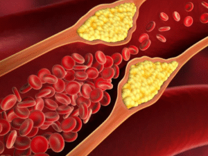 What Causes High Cholesterol? Know the Reasons and Make These Lifestyle Changes Today