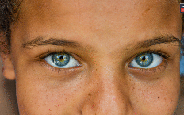 pigmentation 1