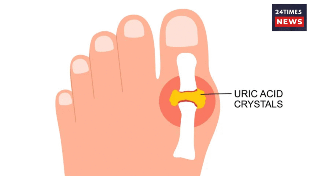 Uric acid is becoming a silent killer, know its symptoms, causes and prevention