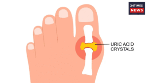 Uric acid is becoming a silent killer, know its symptoms, causes and prevention