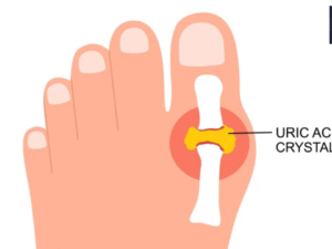 Uric acid is becoming a silent killer, know its symptoms, causes and prevention
