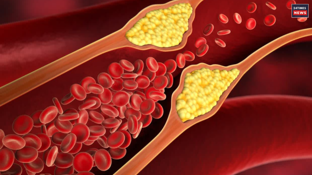 cholesterol issues
