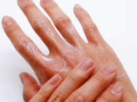 dry hands 1