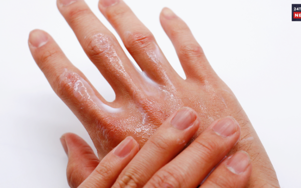 dry hands 1