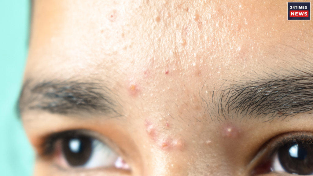 How Should Your Skincare Looks like in your Teenage? Here is the answer